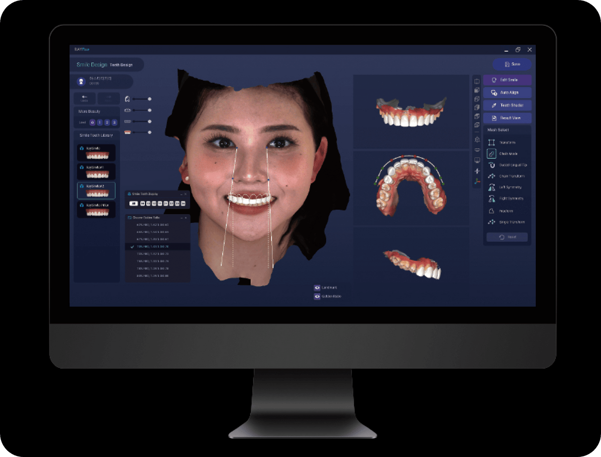 Cyfrowe projektowanie uśmiechu (Digital Smile Design)