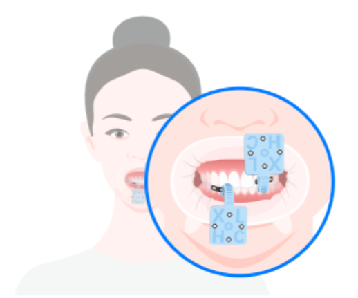 MetiSmile žandikaulio judesių sekikliai su geometriniais gaubteliais